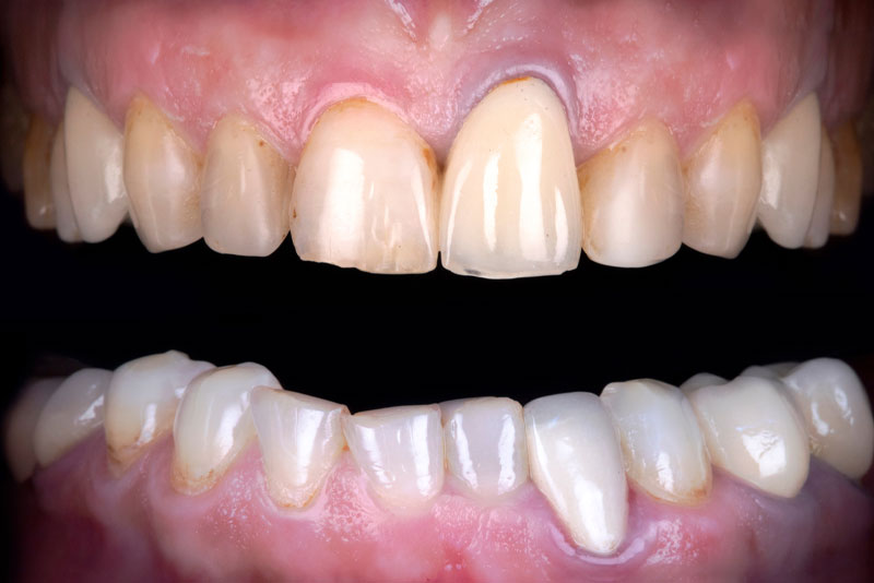 before dental procedure